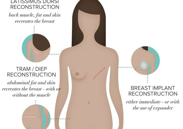 Preventive mastectomy &#8211; what is it and when is it performed?