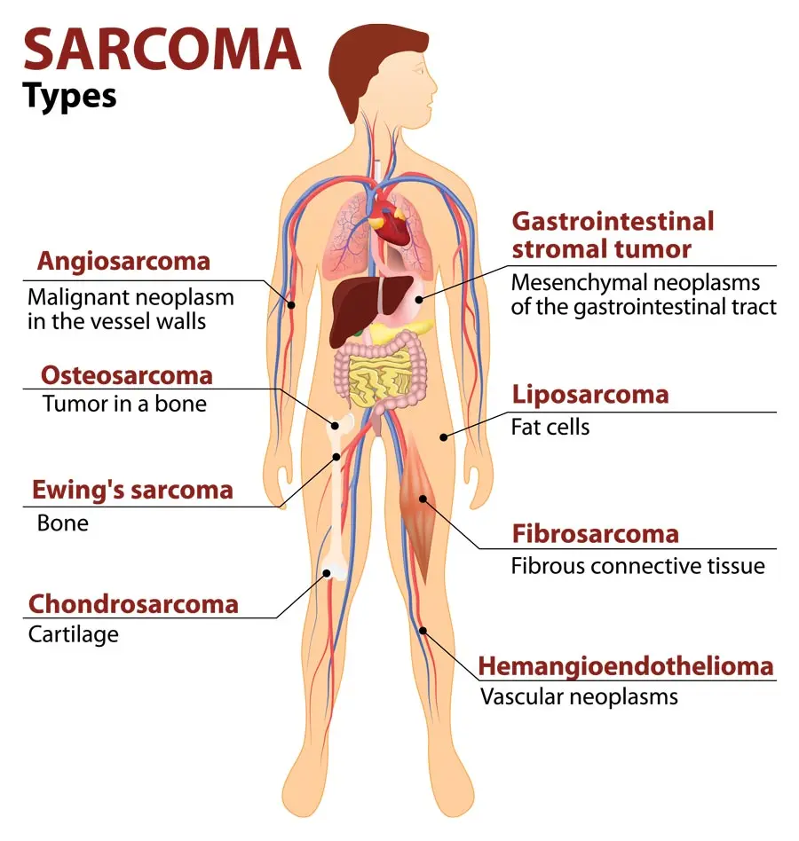 Primary neoplasms of the musculoskeletal system