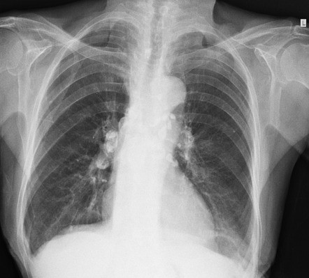 Primary pulmonary tuberculosis