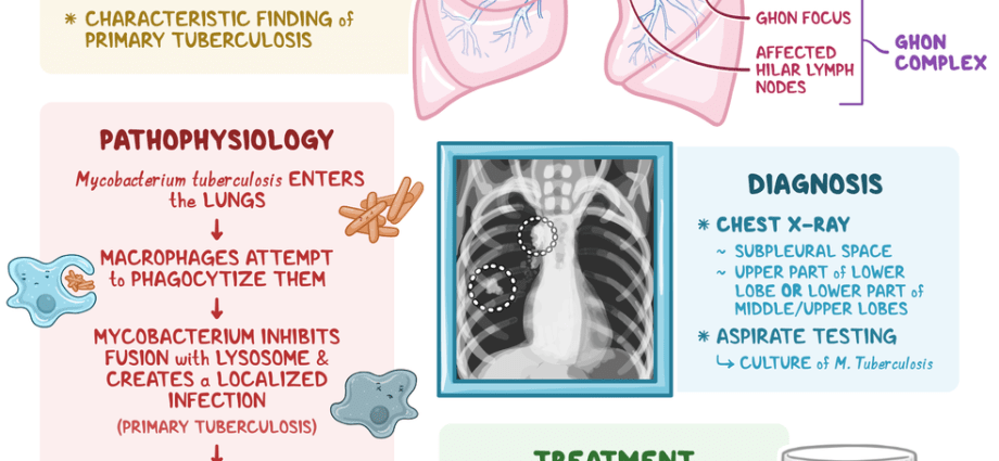 Primary tuberculosis &#8211; causes, symptoms, treatment. Types of post-primary tuberculosis