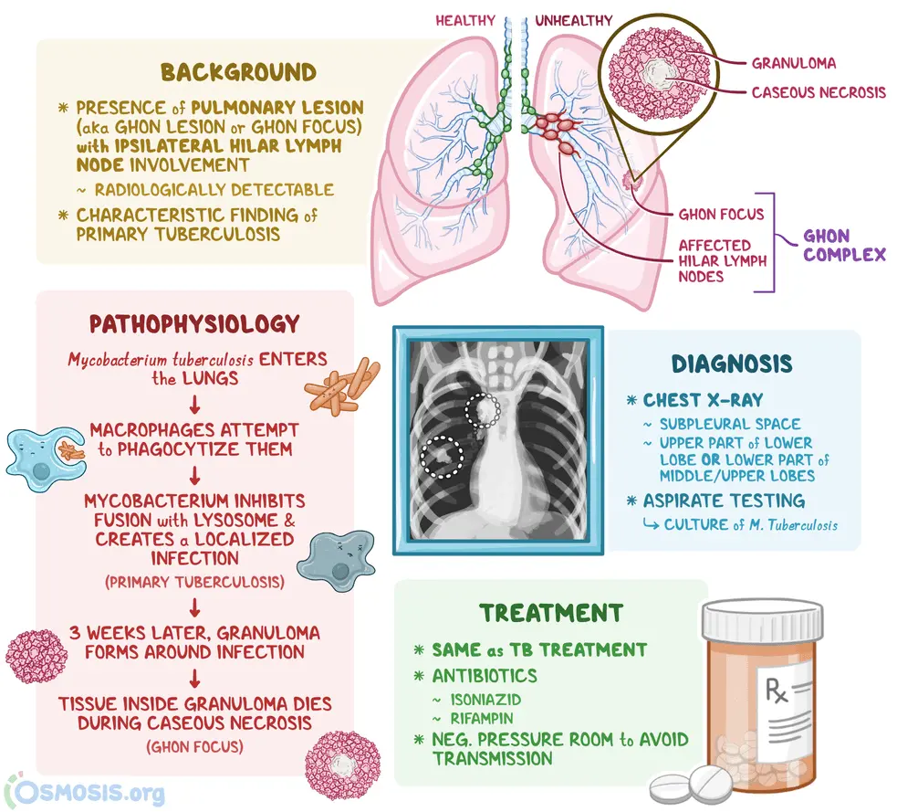 Primary tuberculosis &#8211; causes, symptoms, treatment. Types of post-primary tuberculosis