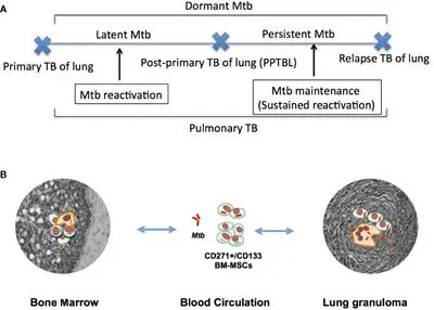 Primary tuberculosis