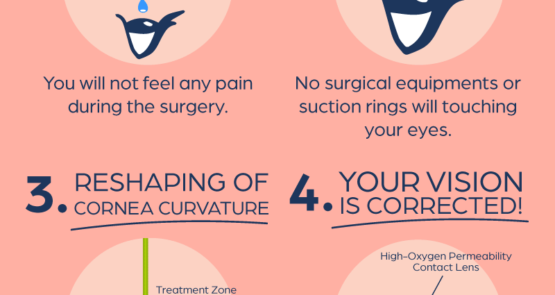 PRK and Trans-PRK. Laser correction of myopia and astigmatism