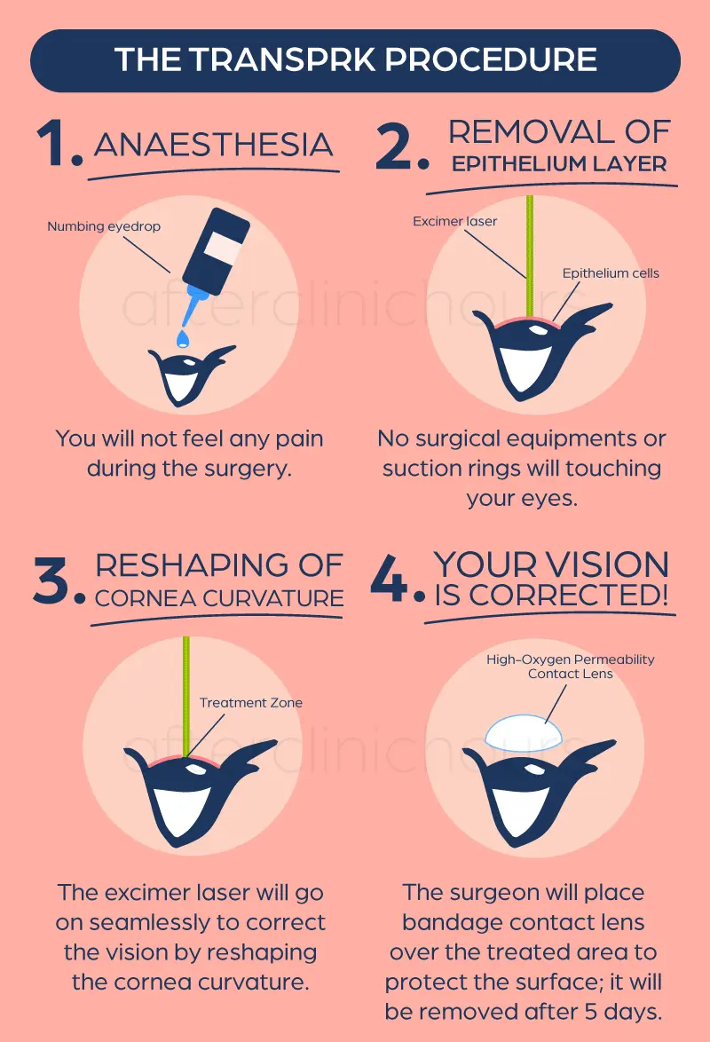 PRK and Trans-PRK. Laser correction of myopia and astigmatism