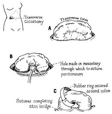 Problems with defecation after gynecological surgeries