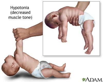 Problems with infant muscle tone