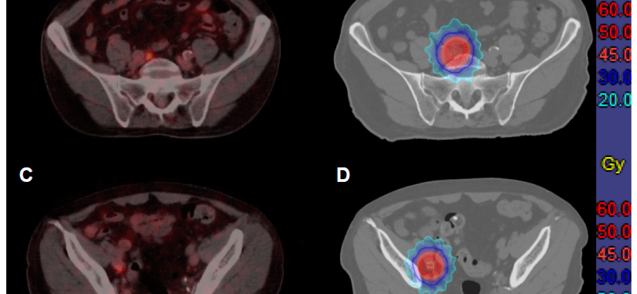 Prof. Caning: Are We Prepared for the Prostate Cancer Epidemic?