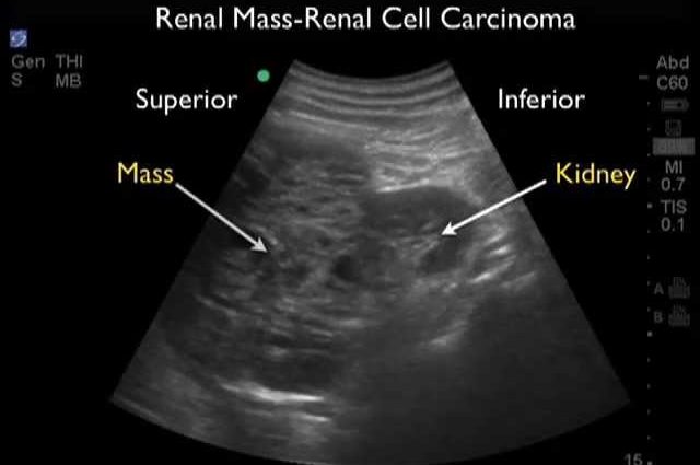 Prof. Szczylik: kidney cancer is best detected by ultrasound