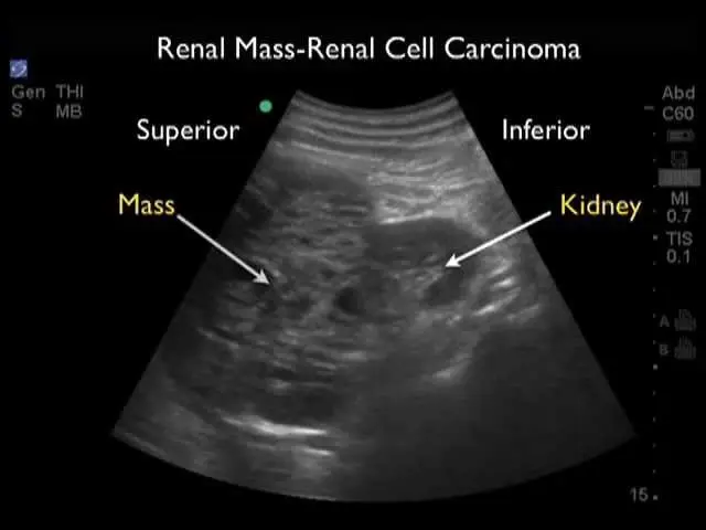 Prof. Szczylik: kidney cancer is best detected by ultrasound