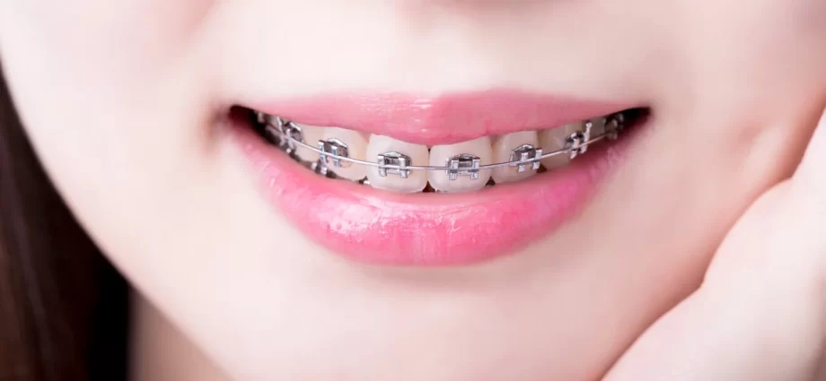 Progenia &#8211; causes and characteristics of the malocclusion. What is the treatment of progenia?