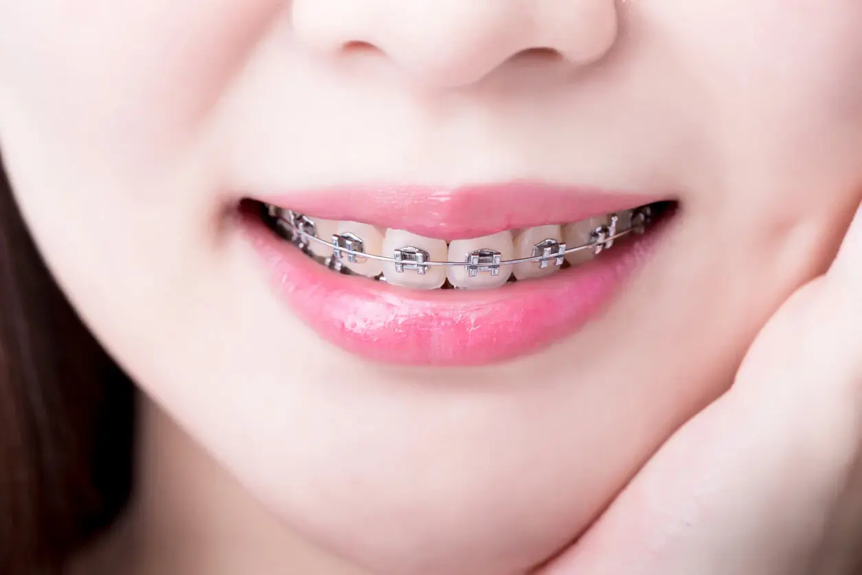 Progenia &#8211; causes and characteristics of the malocclusion. What is the treatment of progenia?