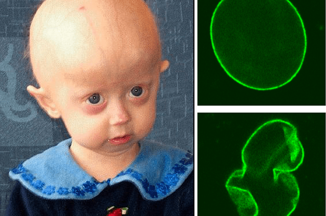 Progeria, a disease in which there is a constant race against time