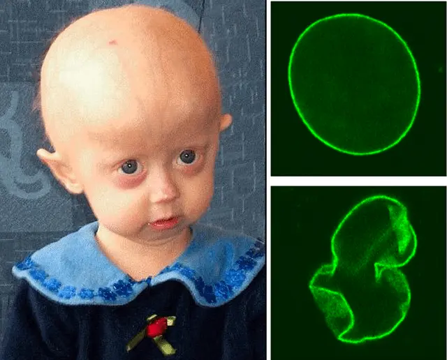 Progeria, a disease in which there is a constant race against time