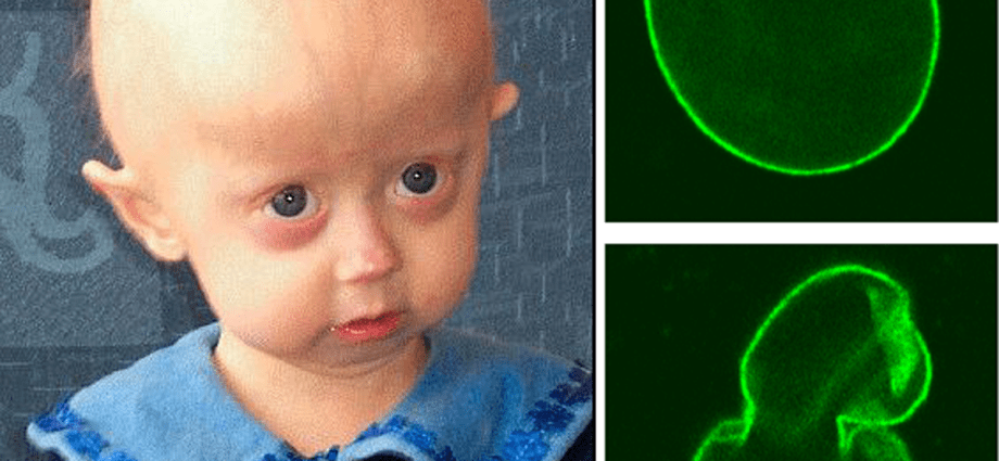 Progeria &#8211; causes, symptoms, diagnosis, treatment. What is progeria?