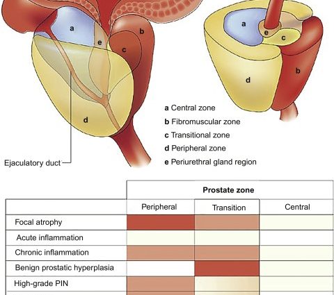 Prostate adenoma &#8211; causes, diagnosis, treatment