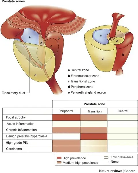 Prostate adenoma &#8211; causes, diagnosis, treatment