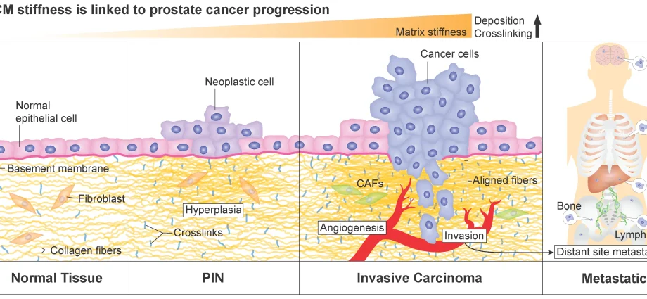 Prostate cancer associated with a higher risk of one of the most dangerous cancers &#8211; colorectal cancer