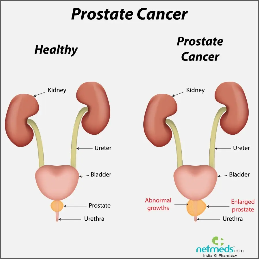 Prostate cancer &#8211; causes, symptoms, treatment and prognosis