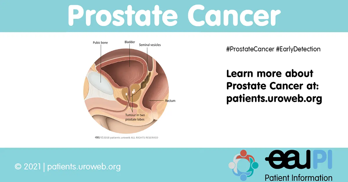 Prostate cancer faq, or what you need to know but are afraid to ask &#8230;