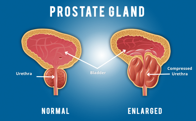 Prostate cancer is one of the most common male cancers in Poland. Every forty-year-old should do this test