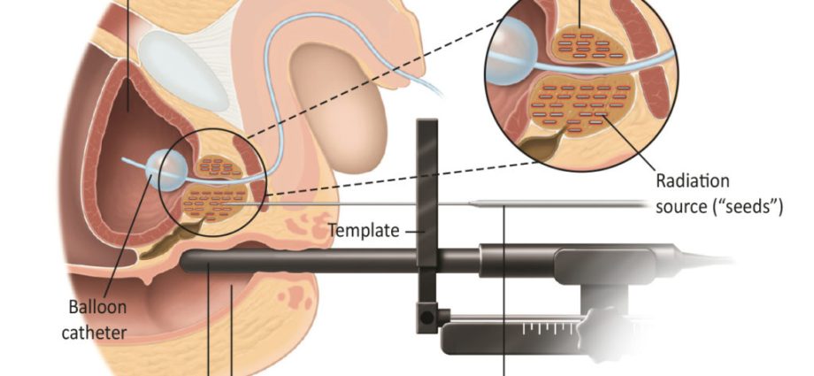 Prostate cancer. Should you be afraid of laparoscopic surgery?