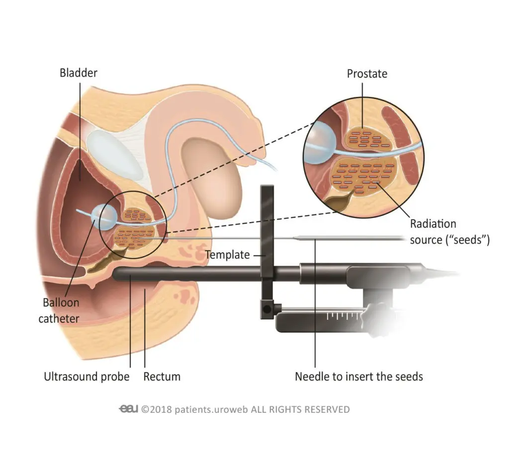 Prostate cancer. Should you be afraid of laparoscopic surgery?