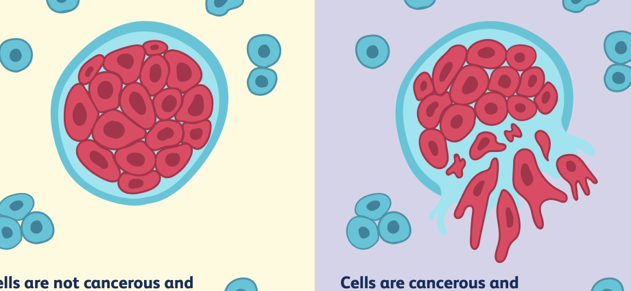 Prostate cancer &#8211; the main symptoms. Treatment of benign and malignant tumors