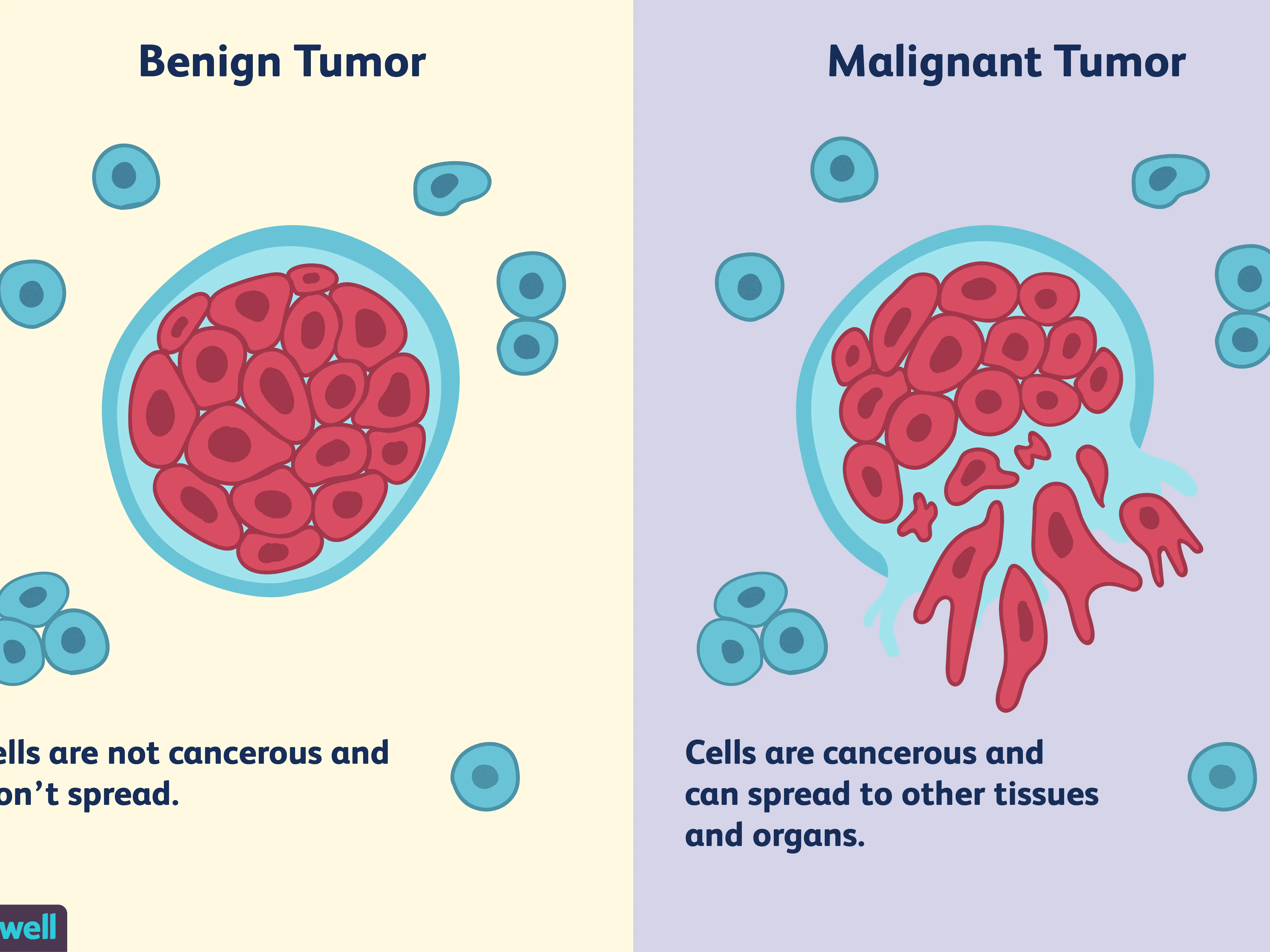 Prostate cancer &#8211; the main symptoms. Treatment of benign and malignant tumors