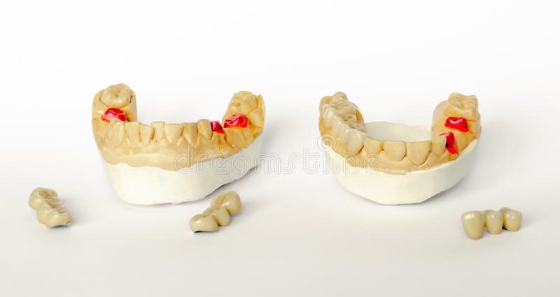 Prosthetics &#8211; generally and in detail. Dental, orthopedic and aesthetic prosthetics