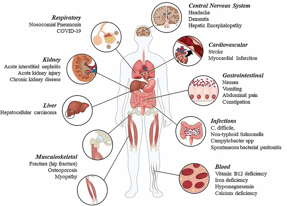 Proton pump inhibitors &#8211; drug action, indications, contraindications and side effects