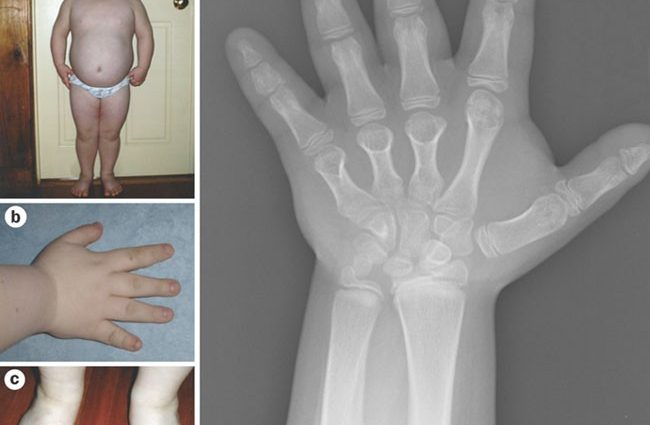 Pseudohypoparathyroidism