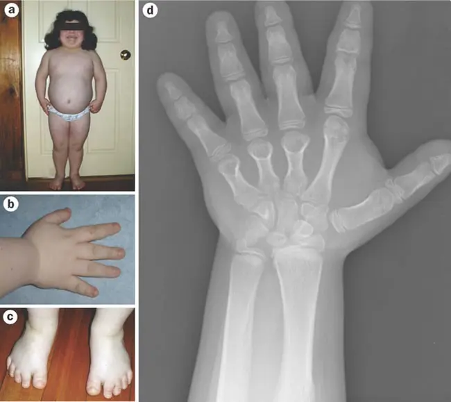 Pseudohypoparathyroidism