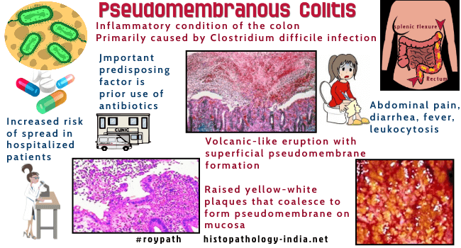 Pseudomembranous enteritis &#8211; a complication after an antibiotic