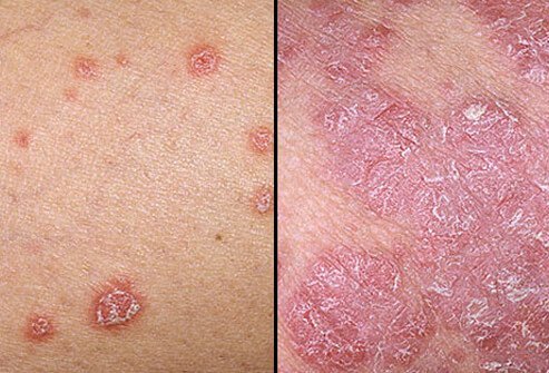 Psoriasis &#8211; causes, symptoms, treatment, photos. What do the different types of psoriasis look like?