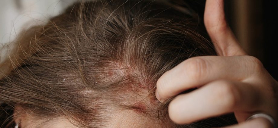 Psoriasis of the head &#8211; symptoms, causes, treatment