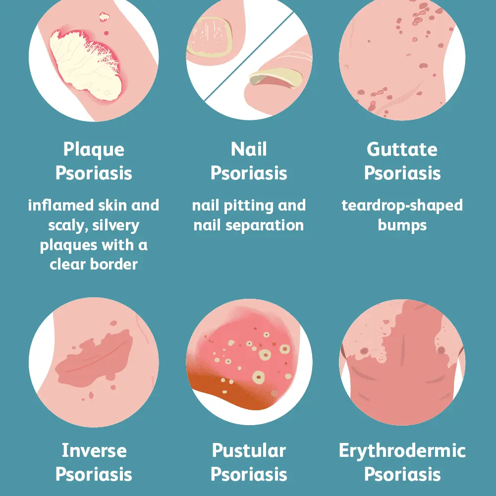 Psoriasis &#8211; treatment of the disease. Symptoms of skin psoriasis