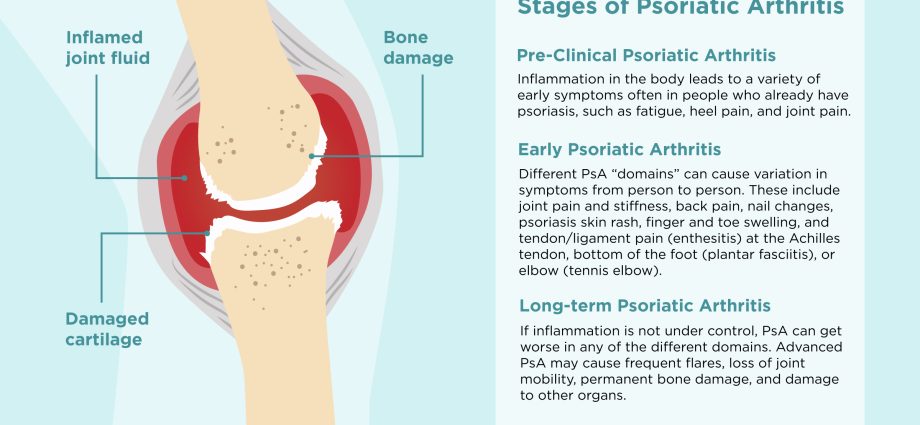 Psoriatic arthritis &#8211; the course of the disease, treatment