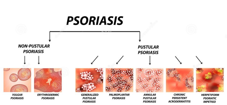 Psoriatic erythroderma