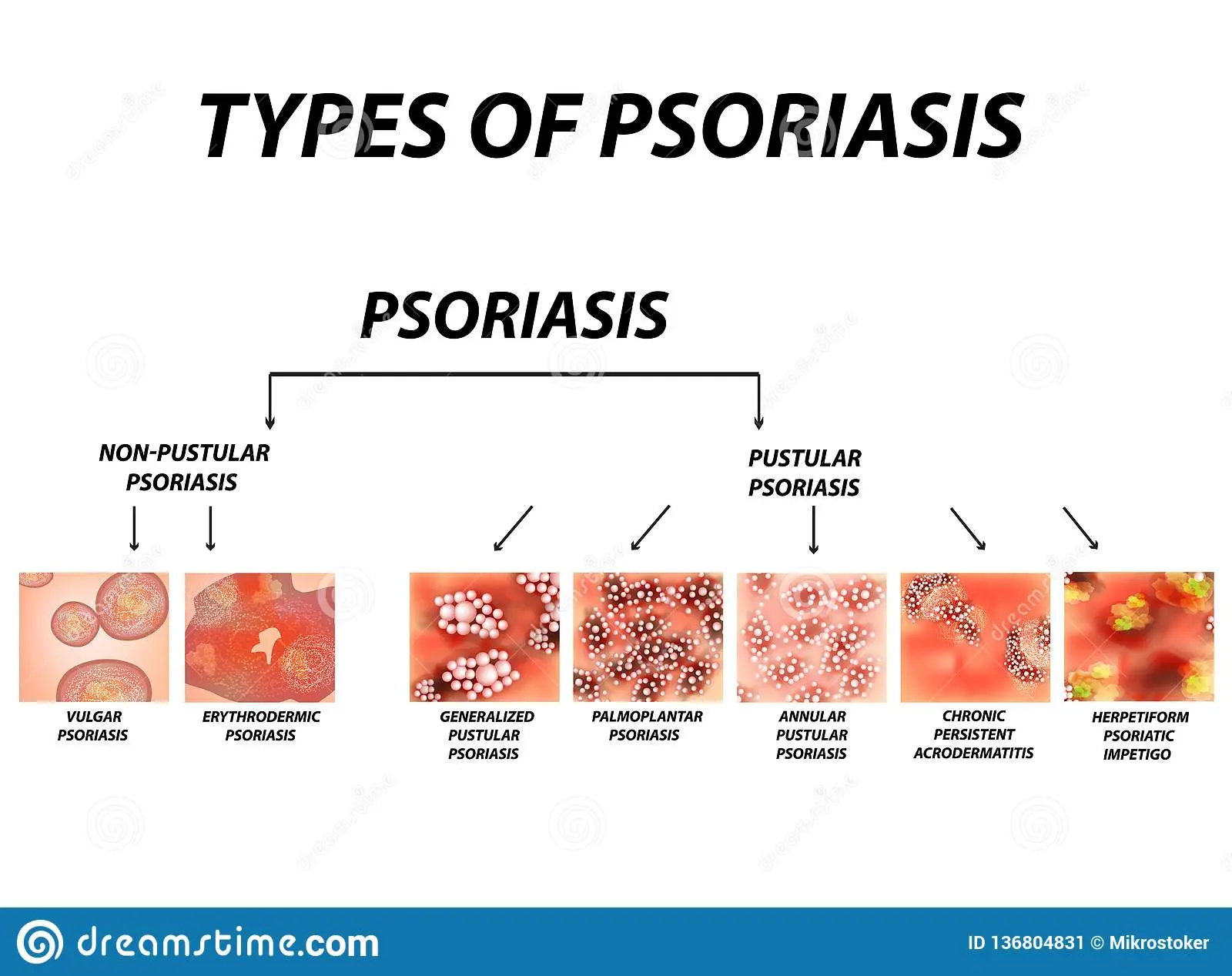 Psoriatic erythroderma