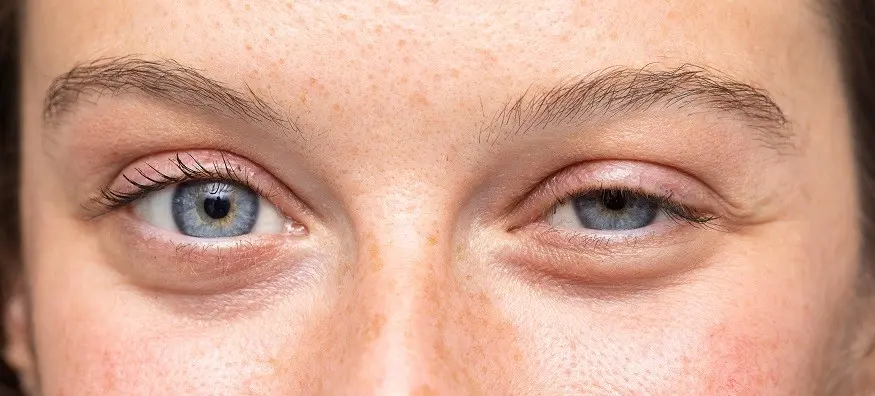 Ptosis &#8211; a drooping eyelid. How to fight the problem?