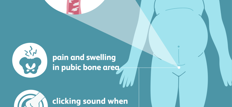 Pubic bone in pregnancy. Pubic bone pain in pregnancy