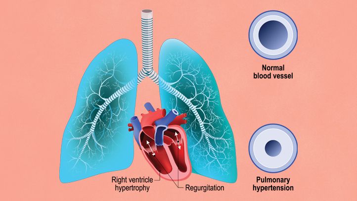 Pulmonary arterial hypertension &#8211; symptoms and treatment. What is life like with TNP?