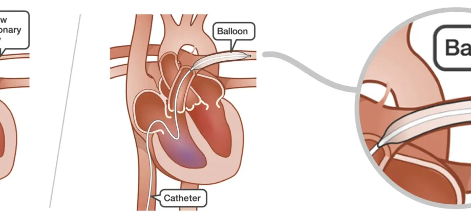 Pulmonary artery angioplasty &#8211; pioneering procedures in Poland