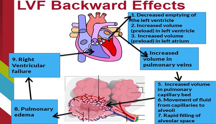 Pulmonary edema &#8211; the leading cause of left ventricular failure