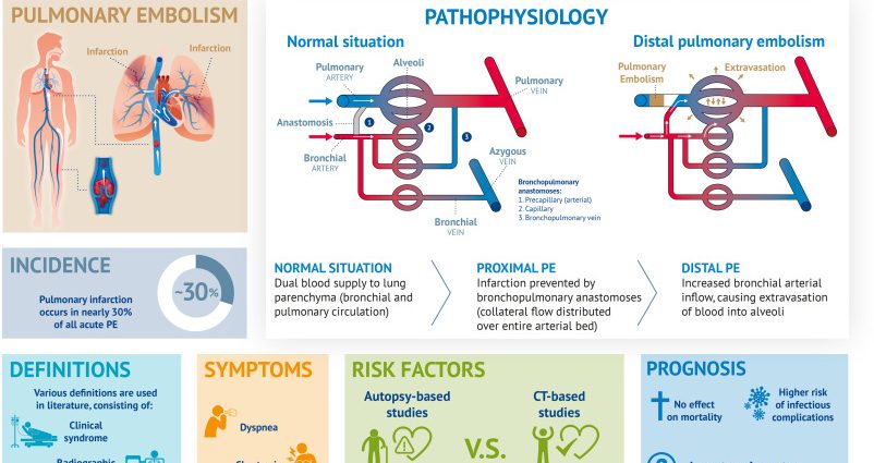 Pulmonary embolism and pulmonary infarction &#8211; what is it, causes, symptoms. How is it diagnosed and treated?