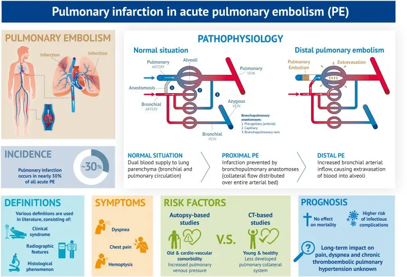 Pulmonary embolism and pulmonary infarction &#8211; what is it, causes, symptoms. How is it diagnosed and treated?