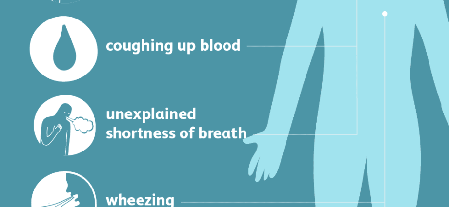 Pulmonary embolism &#8211; symptoms, risk factors, diagnosis, treatment