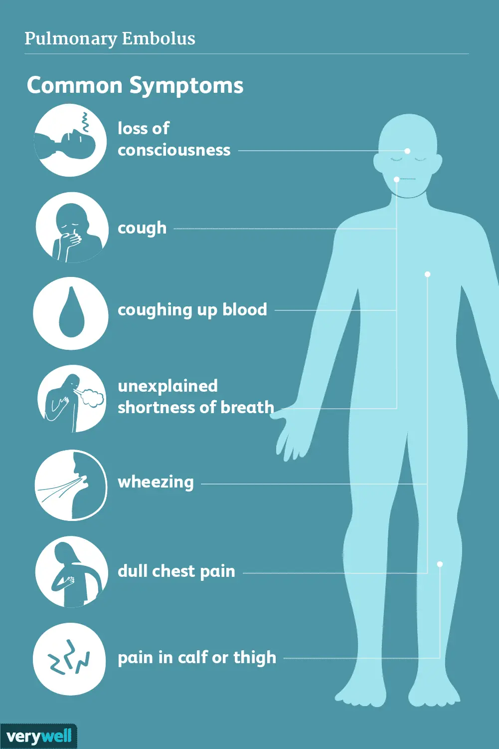 Pulmonary embolism &#8211; symptoms, risk factors, diagnosis, treatment