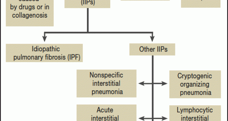 Pulmonary fibrosis &#8211; causes, symptoms and prognosis