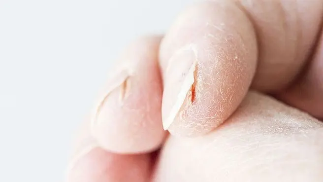 Pulpitis sicca, i.e. drying out of the fingertips. Symptoms and Treatment